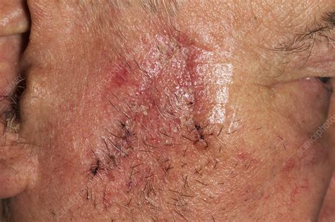 Skin Cancer Scar Stock Image M1310590 Science Photo Library