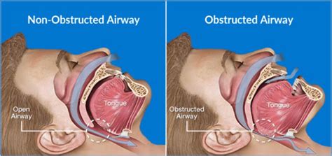 Obstruction Of The Upper Airway Https Sciencebasedmedicine Org