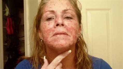 Skin Cancer My Vlogjournal Treatment W Efudex Vid10 Youtube