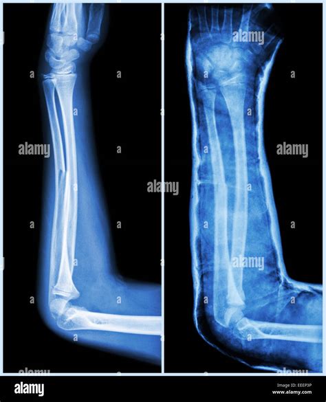 Fracture Shaft Of Ulnar Bone Forearm Bone Left Pre Treatment