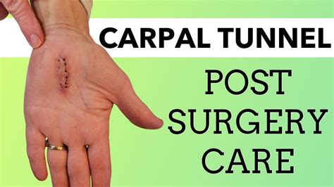 After Carpal Tunnel Surgery Best Exercises To Restore Max Function