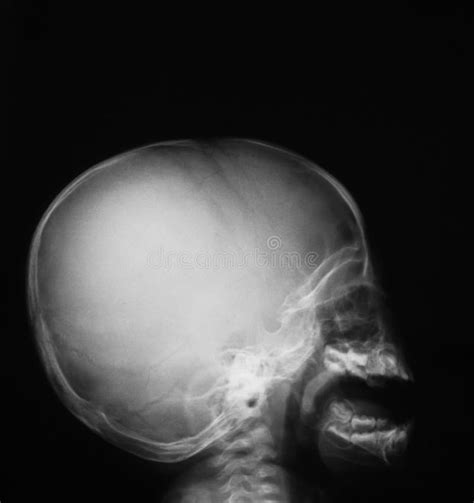 Imagen Del Cráneo Opinión De La Radiografía Del Ap Foto De Archivo