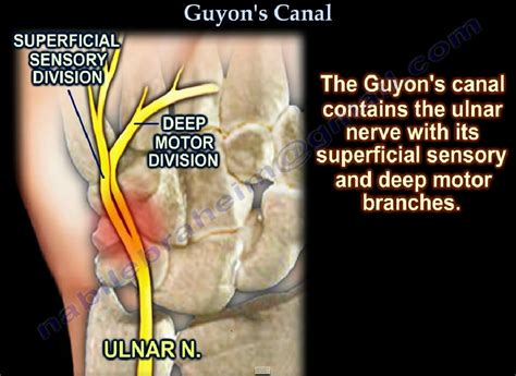 Guyons Canal Ulnar Tunnel Syndrome —