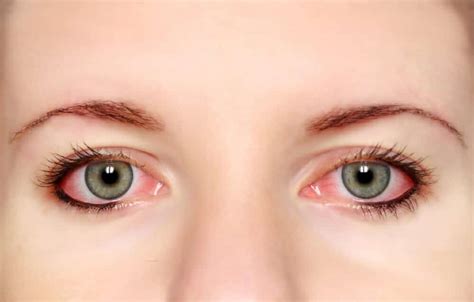 Pink Eye Complications And Treatment And Causes Of Pink Eye