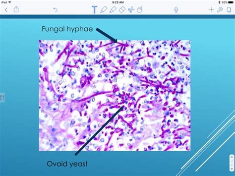 Fungal Infection Ohs Test 8 Flashcards Quizlet