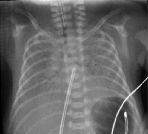 Chest X Ray Shows The Malposition Of The Tip Of The Cvc Into The Left
