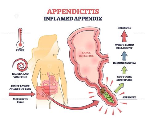 Appendicitis Inflamed Appendix Abdominal Medical Problem Diagnosis