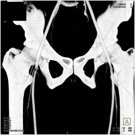 Trauma With Injury To Right Superficial Femoral Artery Sfa Without