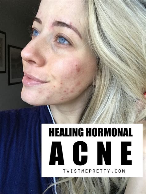How To Clear Up Hormonal Acne My Journey Twist Me Pretty