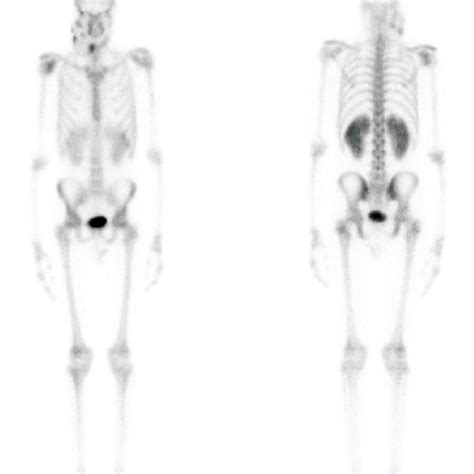 Whole Body Bone Scintigraphy Shows An Area Of Peripheral Increase