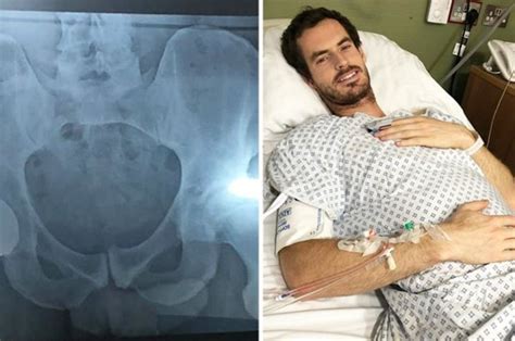 Andy Murray Shares ‘penis Snap In Hip Op X Ray Daily Star