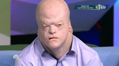Извънземен гост Как изглежда и живее 18 годишно момче с най рядката болест в света СНИМКИ