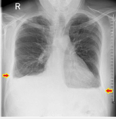 Chest X Ray Showing Bilateral Pleural Effusion And Blunting Of Both