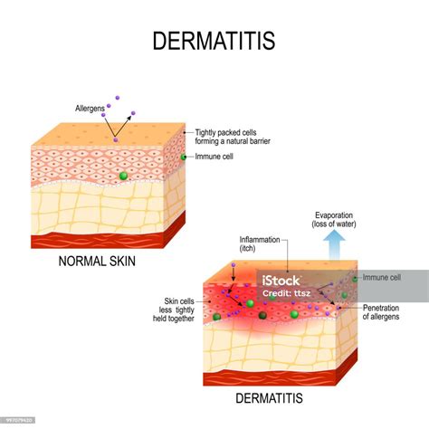 Atopic Dermatitis Stock Illustration Download Image Now Skin