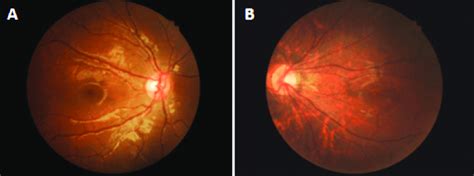Photographs Showing Normal Right Eye A And Markedly Tigroid Fundus In