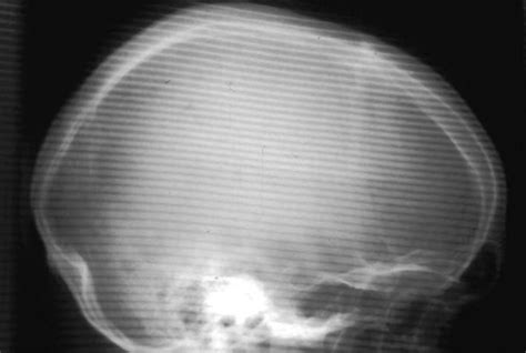 Digital Radiography Image Artifacts Radiology Suny Upstate Medical