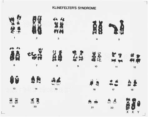 Photograph Klinefelter S Syndrome Karyotype Science Source Images