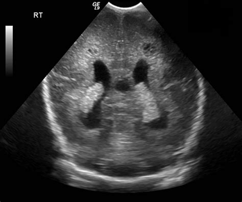 Ivh Neonatal Head Ultrasound