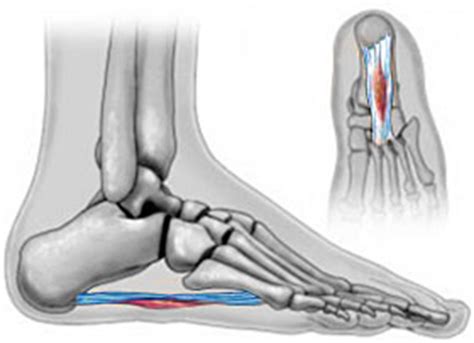 Knot in arch of foot that is painful. Plantar Fibroma Cysts: Causes, Symptoms and Treatment