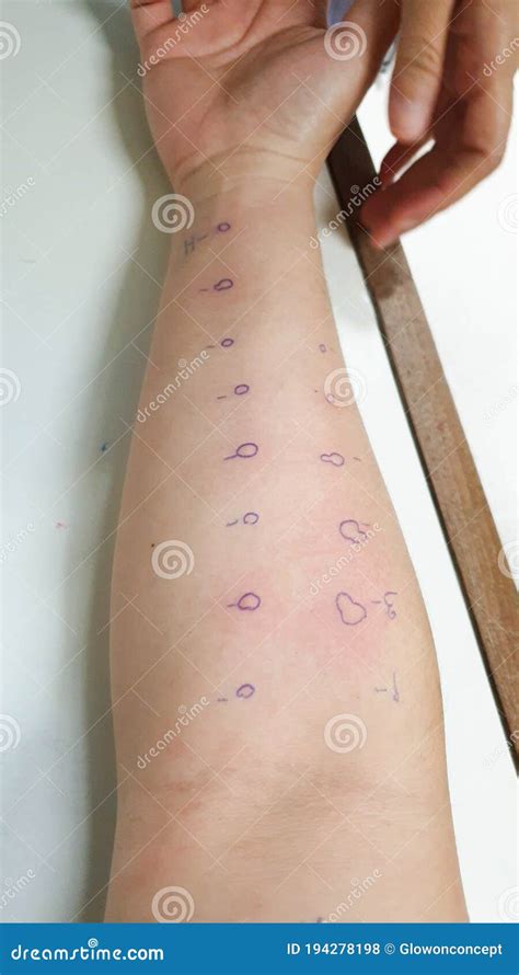 Arm Examine With Allergy Skin Test Rash Reaction Aero Dust Mite
