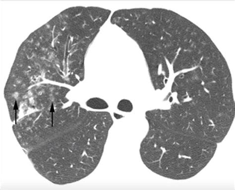 Nodules Centrilobular Lungs