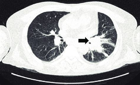 A Spiculated Lesion In The Left Lung Engaging The Pleura Extending To