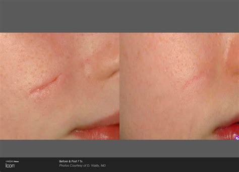 Scar Removal Treatments Lindon Ut