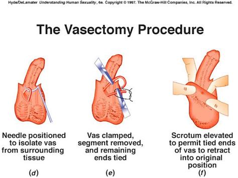 This is to minimize aggravating the areas vasectomies are considered permanent. 12 best Men's Health images on Pinterest