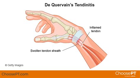 Guide Physical Therapy Guide To De Quervains Tendinitis Choose Pt