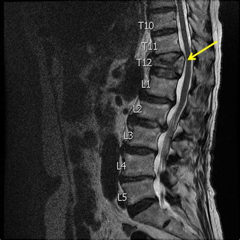 Thoracic Spine Fracture