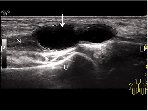 An Intraneural Ganglion Cyst Of The Ulnar Nerve At The Wrist A Case
