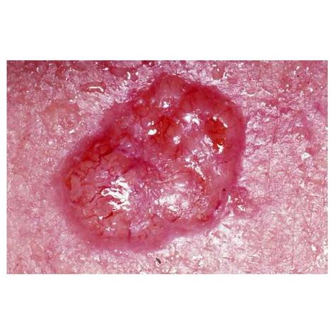 Skin Cancer Warning Signs Identifying Basal Cell Carcinoma Symptoms