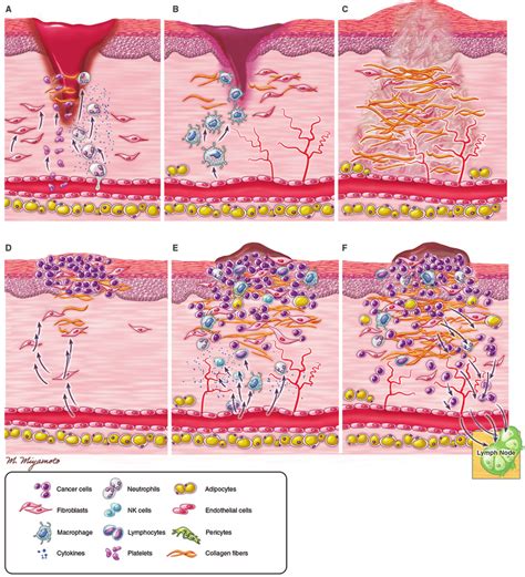 Comparative Models Of Wound Healing And Tumor Stroma A The First