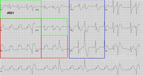 Ecg Rhythms Inferior Wall Mi