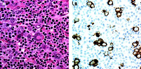Nodal Aggressive B Cell Lymphomas A Diagnostic Approach Journal Of