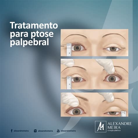 Ptose Palpebral trata se de um termo médico usado para definir a queda