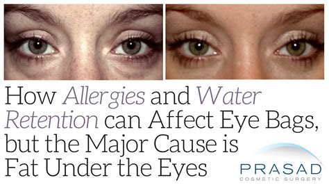 How Allergies And Water Retention Can Affect Eye Bags But The Major