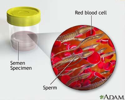 Blood In Semen MedlinePlus Medical Encyclopedia Image