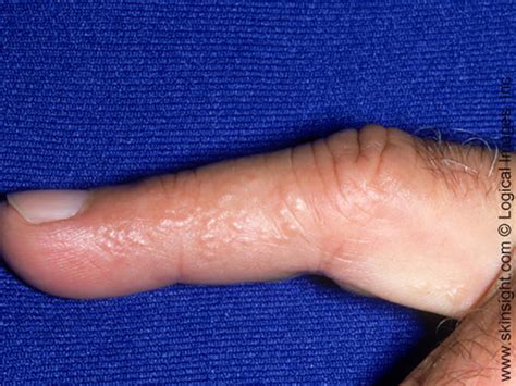 You were dreaming about blisters on hand, right? Types of Eczema: Dyshidrotic Eczema | National Eczema ...