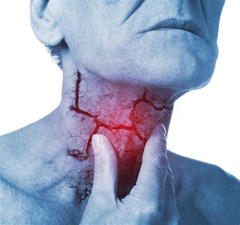 What Are The Treatment Signs Of Throat Cancer In Humans