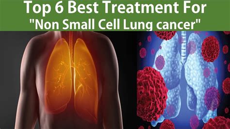 Top 6 Best Non Small Cell Lung Cancer Treatment Treatments Are
