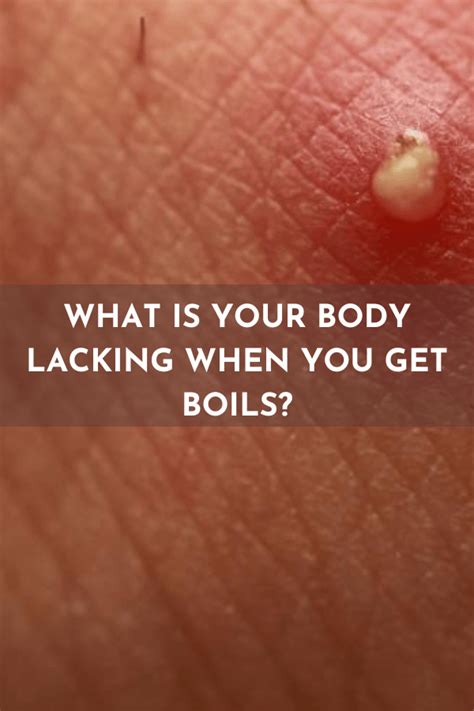 What Is Your Body Lacking When You Get Boils
