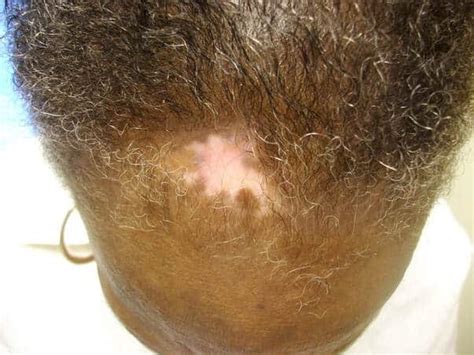 How To Stop Lupus Hair Loss In The Video Below