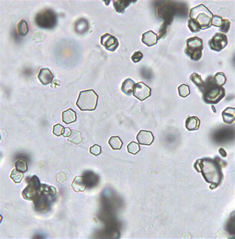 Amorphous Phosphate Crystals In Urine