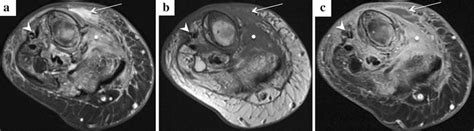 Mri Of The Same Patient As In Fig 1 Shows Extensive Cellulitis