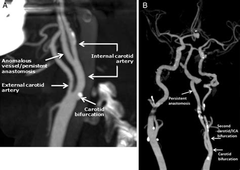 Vascular Surgery Carotid Artery Vascular