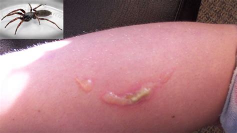 Check spelling or type a new query. Bites and Stings: Pictures, Causes, and Symptoms