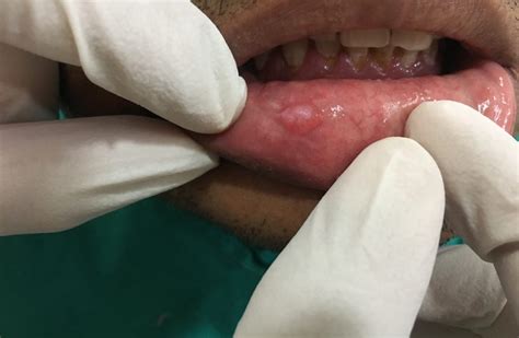 mucocele over lower lip shashwatt