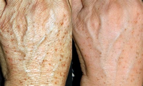 If you notice brown spots on your neck, they are most likely a type of hyperpigmentation, which is referred to as solar lentigines. Erase Brown Spots on Hands with Sugar | Brown spots on ...