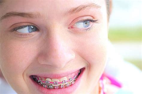 Смотреть Девушки с брекетами на зубах 47 фото